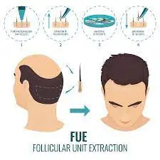 fue hair transplant