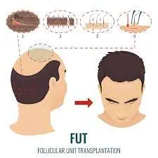 fut hairtransplant