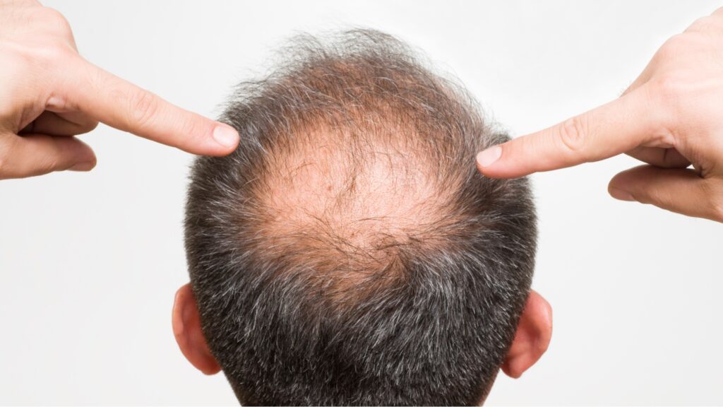 How to Regrow Hair on Bald Spot Fast?
